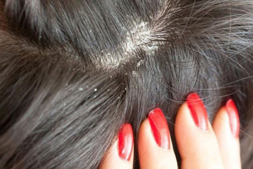 Biết cách gội đầu bạn sẽ không cần phải lo về gàu