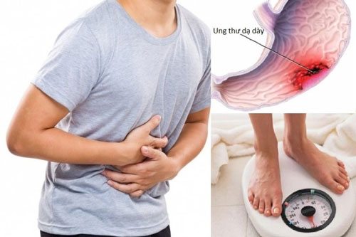 5 dấu hiệu không đau nhưng cảnh báo ung thư dạ dày