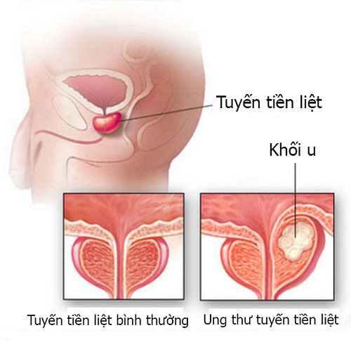 Dấu hiệu của ung thư tiền liệt tuyến là gì?