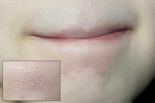 Hỗn hợp có thể đánh bay mụn cám trong nháy mắt