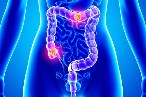 Nguy cơ ung thư ruột từ những thói quen nhiều người dễ mắc phải