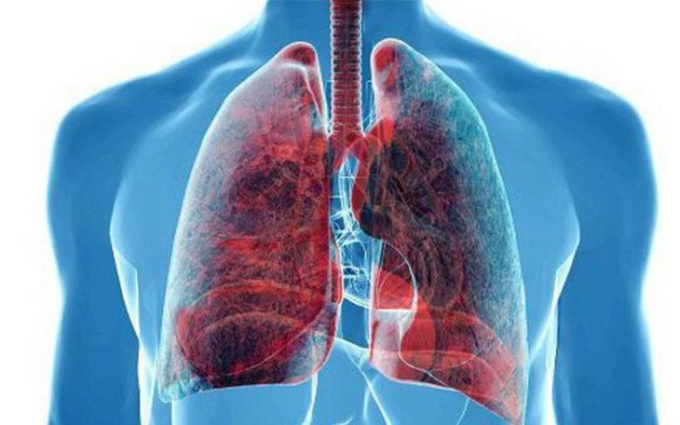Dấu hiệu cảnh báo ung thư phổi đã nghiêm trọng