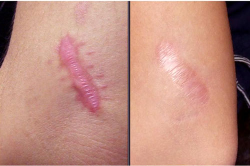 Công thức chữa sẹo lồi cực nhanh chưa hết 10 nghìn đồng