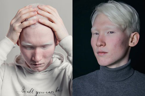 CLIP: Người mẫu bạch tạng nổi tiếng tại Kazakhstan