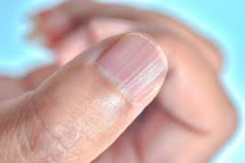 Có đường sọc dọc trên móng tay ngầm cảnh báo 3 vấn đề sức khỏe mà bạn không nên chủ quan coi thường