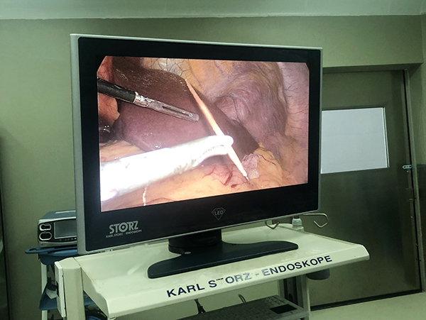 Đà Nẵng: Nội soi ổ bụng, lấy ra chiếc tăm tre nhọn đâm thủng dạ dày xuyên qua gan