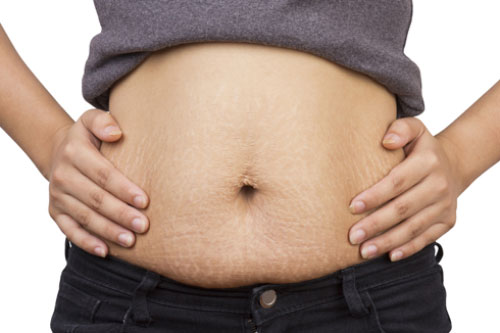 Áp dụng ngay cách dưới đây rạn da lâu năm đến mấy cũng mờ dần