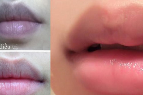 Công thức đặc biệt với quả chanh để hết môi thâm