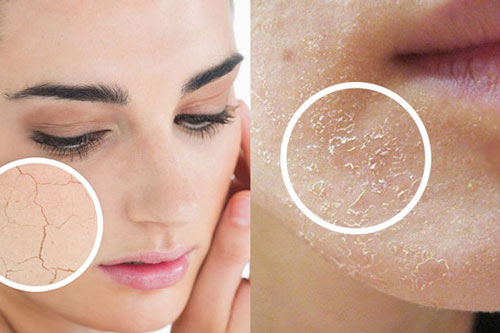 2 cách khắc phục tình trạng da khô ráp