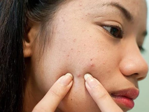 Tác hại của nặn mụn sai cách
