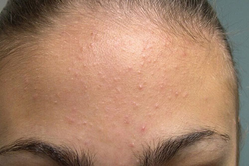 "Giải cứu" làn da bị mụn trong mùa hanh khô