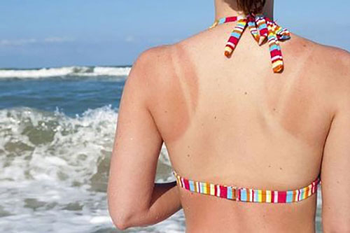 4 nguyên liệu nhà bếp phục hồi làn da cháy nắng hiệu quả