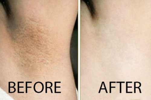 5 công thức hết thâm nách tại nhà bạn gái bắt buộc phải biết