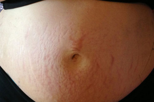 Mẹo chữa rạn da trong nháy mắt mà không cần dùng mỹ phẩm