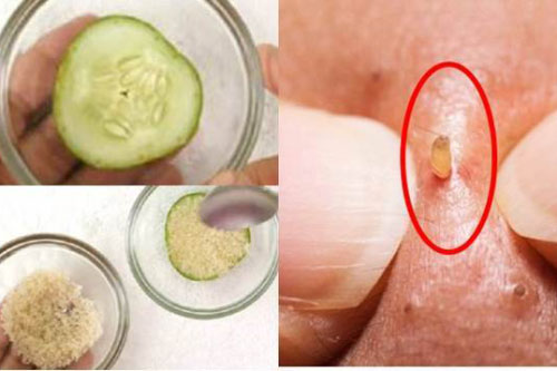 Dùng dưa chuột chấm đường chà vào mặt mụn đầu đen tự bong hết