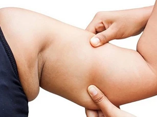Tại sao bắp tay lại bị tích mỡ?