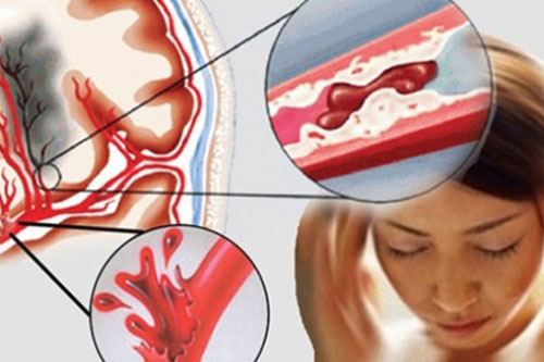 Dấu hiệu cảnh báo mạch máu bị tắc nghẽn