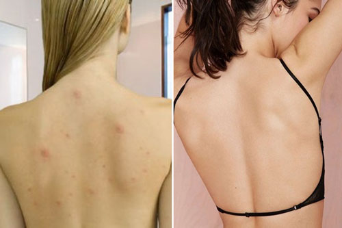 Những cách trị sạch mụn ở lưng vô cùng đơn giản