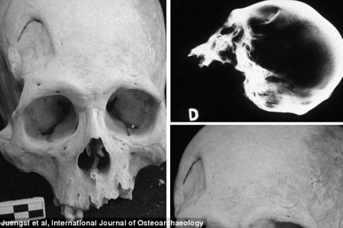 Khảo cổ học tìm thấy xương cổ đại minh chứng quá trình phẫu thuật não nguyên thủy