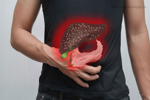 Không muốn chết vì gan nhiễm mỡ bạn hãy dừng ăn thực phẩm này