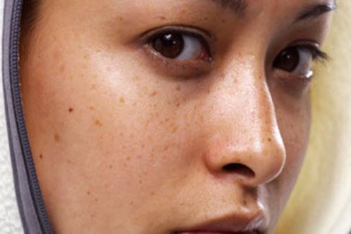 Lý do khiến làn da ngày càng thâm sạm, xỉn màu