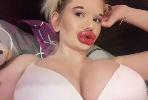 Cô gái từng bơm môi 20 lần để có 'bờ môi khủng nhất thế giới' nay lại phẫu thuật tăng 4 size vòng một