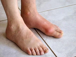 Người bị bệnh gout nên ăn gì?