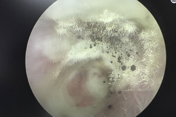 Người đàn ông bị ngứa tai, bác sĩ kinh hãi khi tiến hành kiểm tra tai và nhìn thấy hình ảnh do người vợ cung cấp