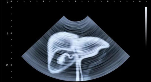 Chuyên gia chỉ điểm 5 kiểu người dễ ung thư gan, bạn có trong số đó?