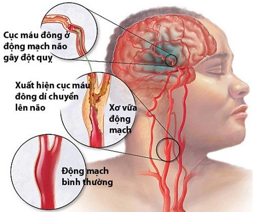 4 sai lầm khi xử lý người bị đột quỵ nhiều người mắc phải để lại hậu quả đáng tiếc - Ảnh 2.