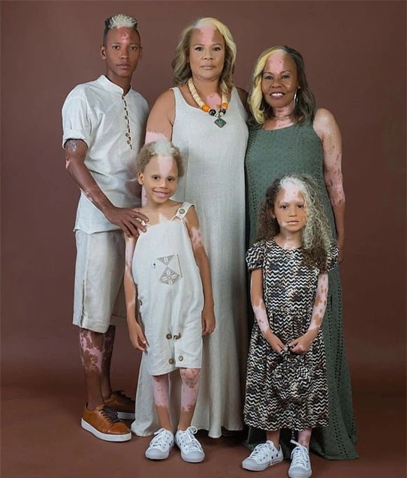 Gia đình ba thế hệ cùng có mảng da tóc màu lạ - Ảnh 2.