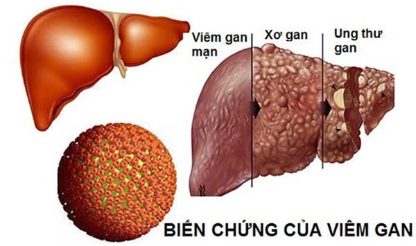 Giám đốc 40 tuổi bị ung thư gan vì làm 4 việc trong thời gian dài