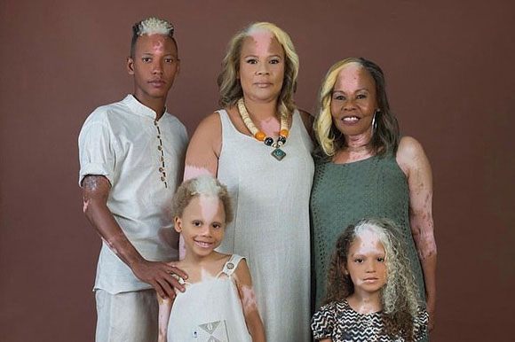 Gia đình ba thế hệ cùng có mảng da tóc màu lạ