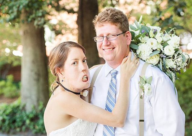 Cô gái Mỹ mắc bệnh lạ, không thể khép miệng