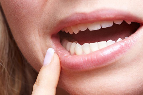 Dấu hiệu ung thư miệng bạn cần đi khám ngay