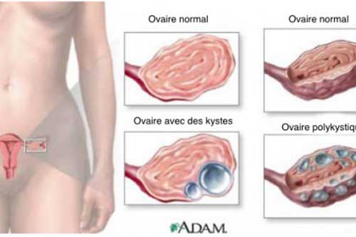 9 điều cực quan trọng về u nang buồng trứng