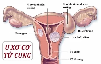 U xơ tử cung là bệnh phụ khoa phổ biến trong độ tuổi sinh sản.