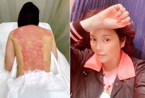 Lý Nhã Kỳ gây chú ý vì đăng ảnh tấm lưng trần chằng chịt dấu đỏ sau khi giác hơi