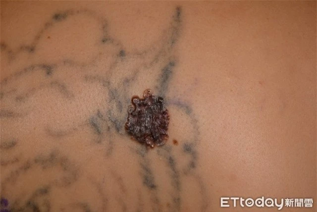 Xuất hiện khối u lạ trên hình xăm, người phụ nữ được chẩn đoán mắc bệnh ung thư da - Ảnh 1.