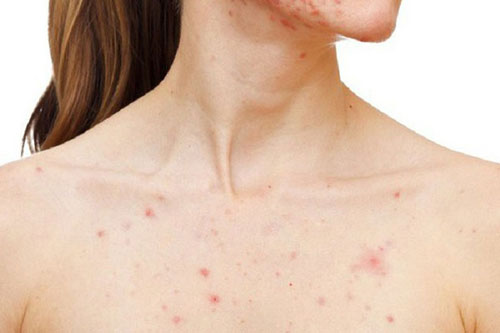 Mụn mọc ở ngực có nguy hiểm không?