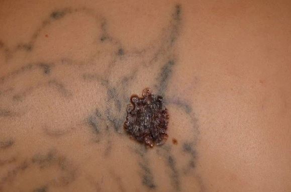 Xuất hiện khối u lạ trên hình xăm, người phụ nữ được chẩn đoán ung thư da, càng bất ngờ hơn khi nghe bác sĩ nói nguyên nhân