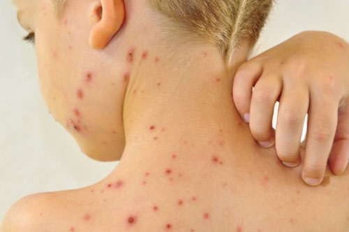 Thói quen cần tránh khi bị thủy đậu khiến bệnh càng nặng và để lại sẹo