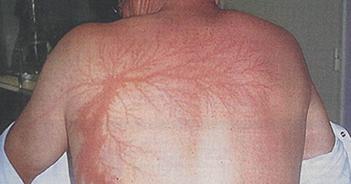 Điều kinh khủng gì sẽ xảy ra nếu bạn bị sét đánh?