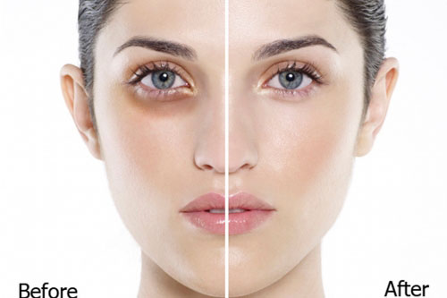 Mắt như 'gấu trúc' cũng hết thâm chỉ với phương pháp này