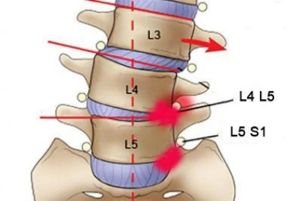 Thoát vị đĩa đệm thắt lưng thường xảy ra ở vị trí L4 L5, L5 S1.