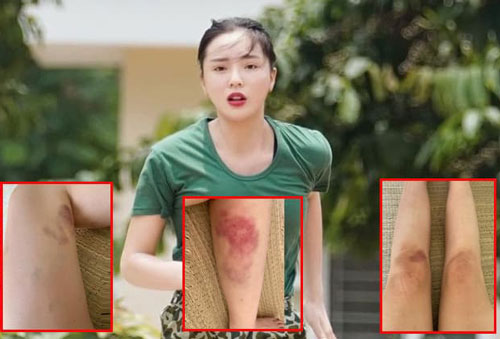 Fans xót xa khi chứng kiến đôi chân te tua, bầm dập của Hoa hậu Kỳ Duyên sau khi tham gia 'Sao nhập ngũ'