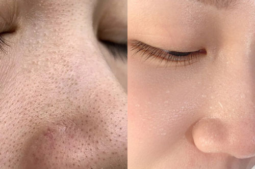 Cách nặn mụn đầu đen không để lại sẹo thâm