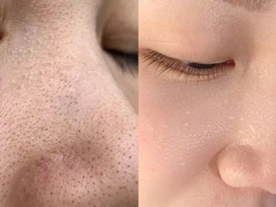Cách nặn mụn đầu đen không để lại sẹo thâm