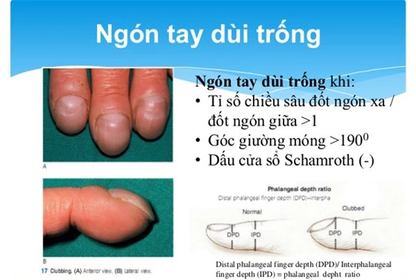 Những dấu hiệu ở móng tay cảnh báo bạn mắc bệnh nặng, có cả ung thư