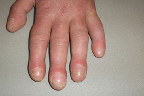 Những dấu hiệu ở móng tay cảnh báo bạn mắc bệnh nặng, có cả ung thư